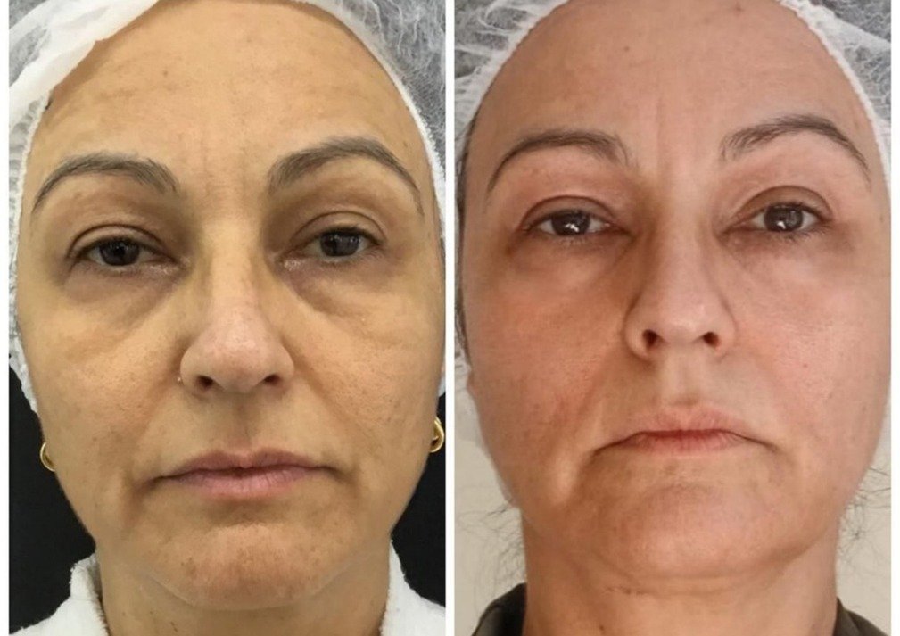 Caso Clínico Rejuvenescimento Facial com CO2 Fracionado